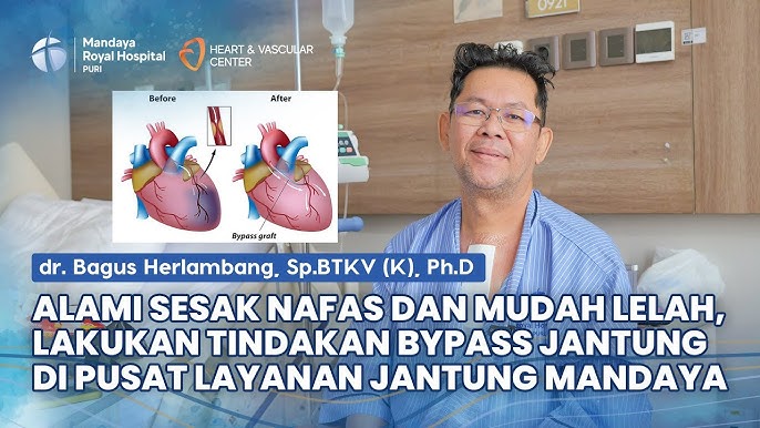 Pengalaman Pasien Operasi Bypass Jantung di RS Mandaya Royal Puri Bersama dr. Bagus Herlambang