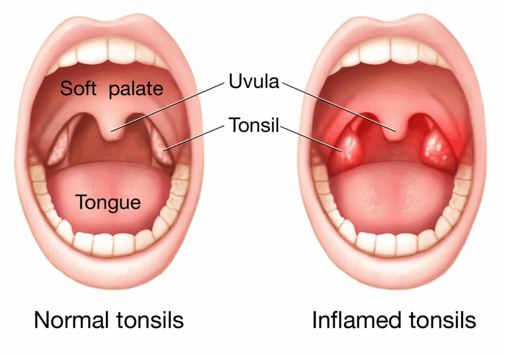 Radang amandel atau tonsilitis (Sumber: Mayo Clinic) 
