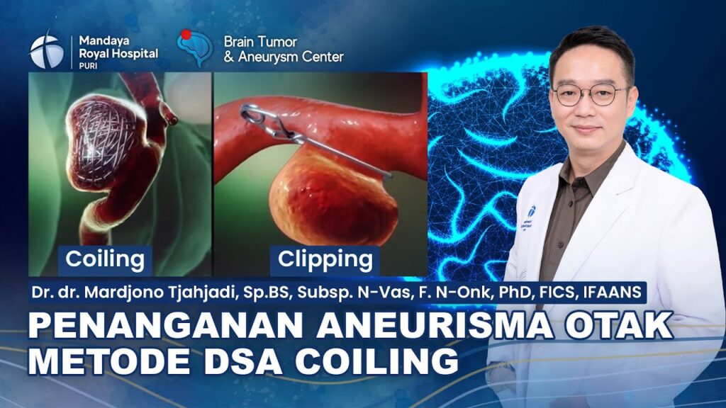 Endovascular Coiling untuk Tangani Aneurisma Otak, Tersedia di RS Mandaya Puri