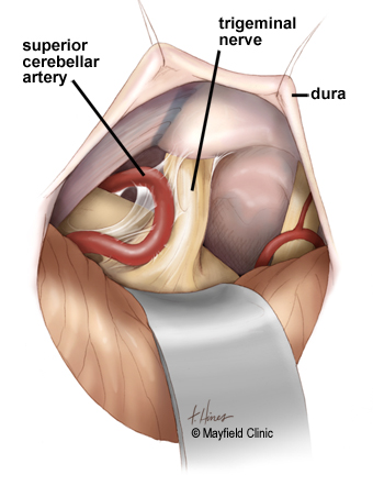 Prosedur MVD (Sumber: Mayfield Clinic)