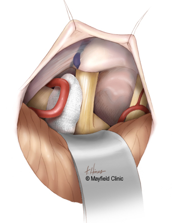 Prosedur MVD (Sumber: Mayfield Clinic)
