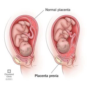 Plasenta previa (Sumber: Cleveland Clinic)