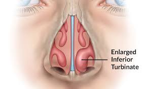 Hipertrofi Konka (Sumber: St. Louis Sinus Center)