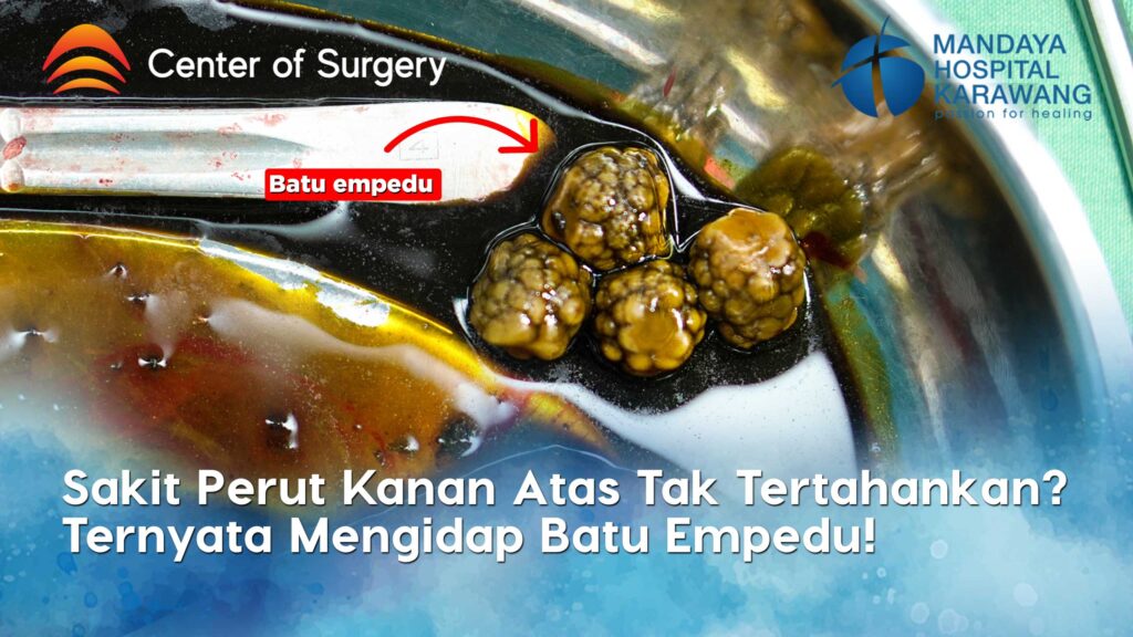Sakit Perut Kanan Atas Tak Tertahankan? Waspadai Batu Empedu!