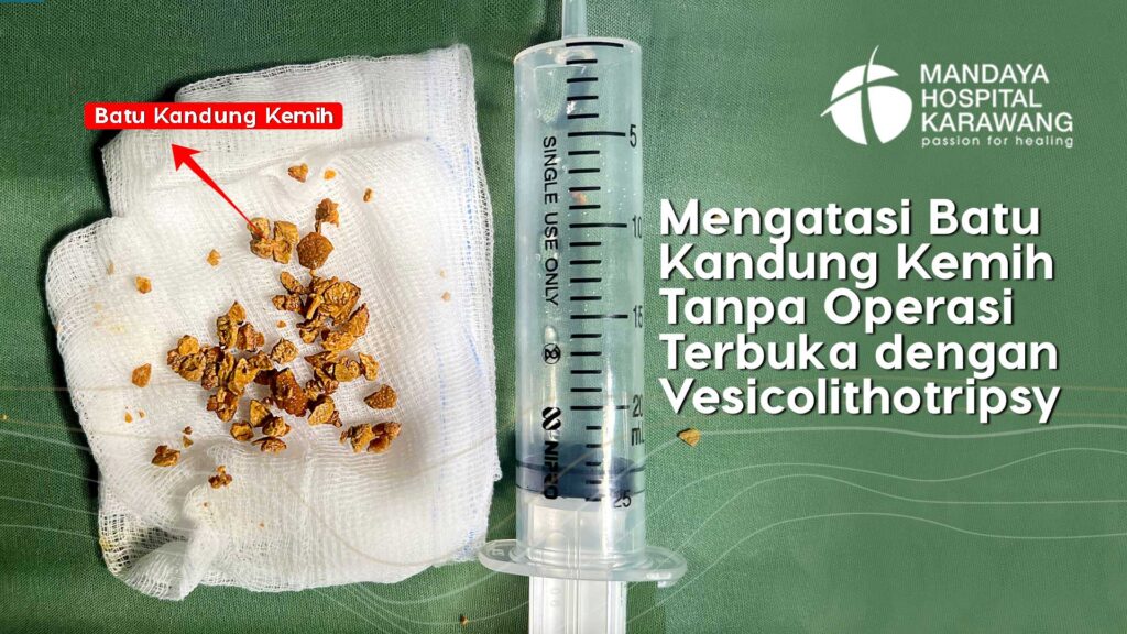 Mengatasi Batu Kandung Kemih Tanpa Operasi Terbuka dengan Vesicolithotripsy di Karawang