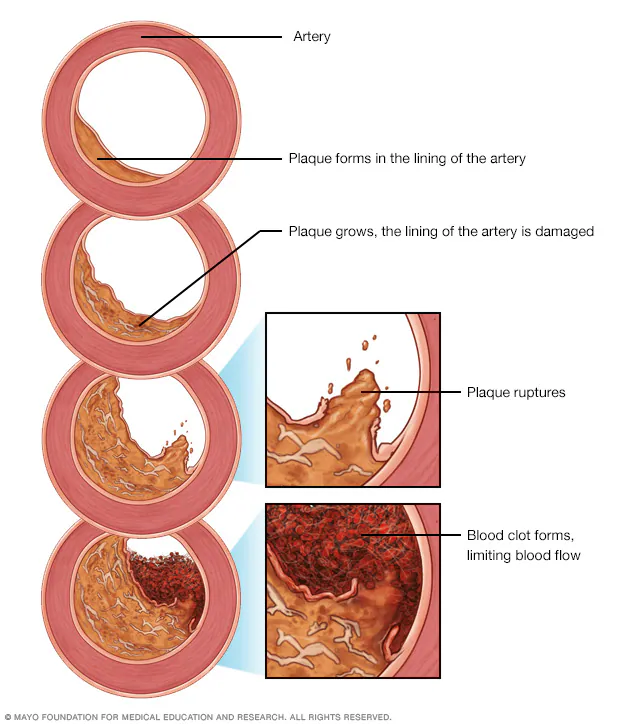 Aterosklerosis (Sumber: Mayo Clinic)