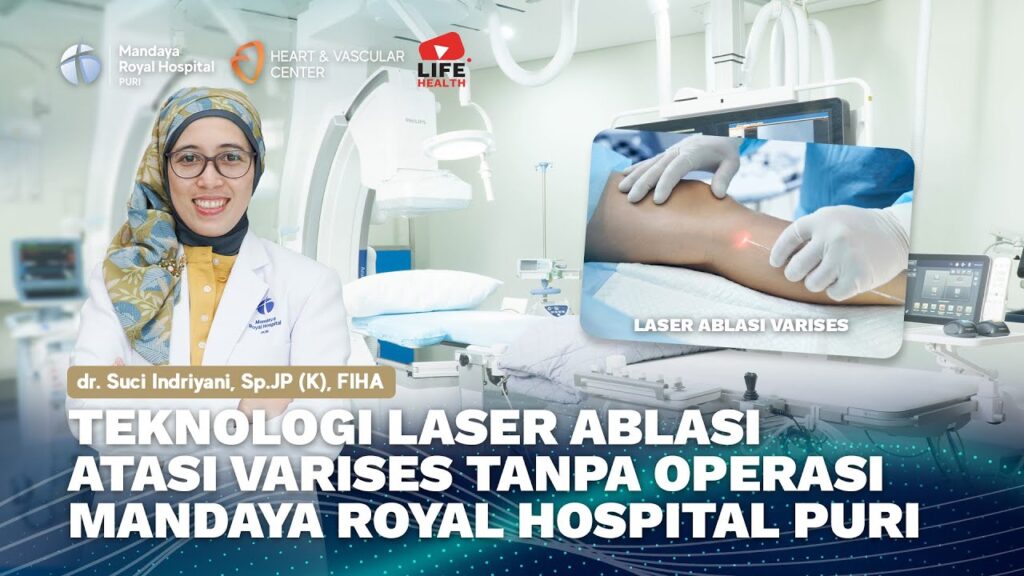 Pengobatan Varises Kaki Tanpa Operasi Besar dengan Laser Ablasi di RS Mandaya Puri oleh dr. Suci