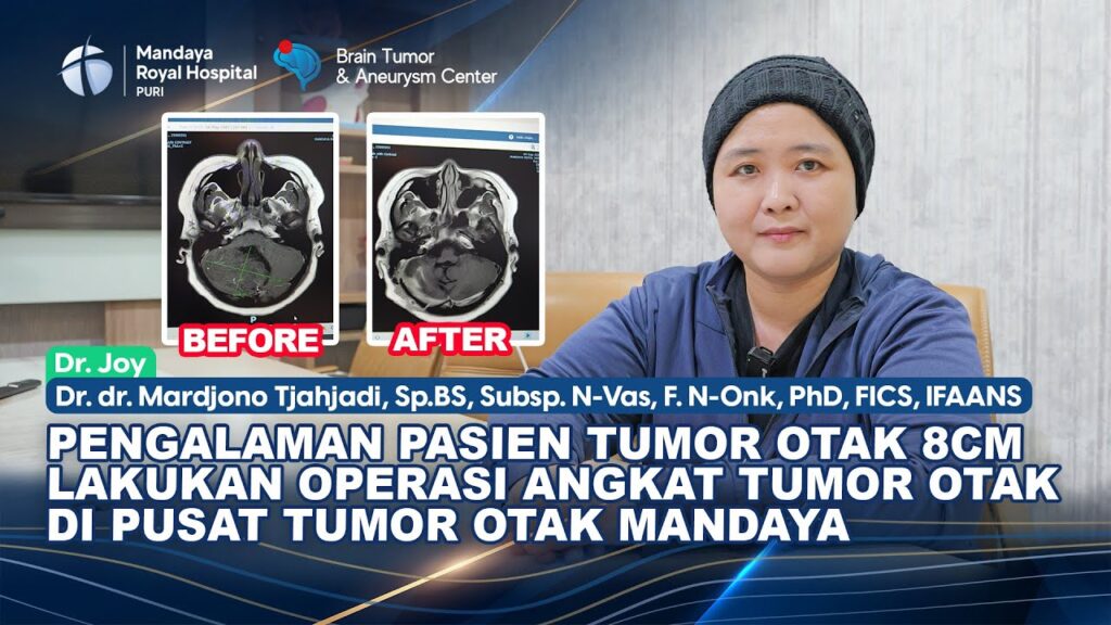 Pengalaman Pasien Tumor Otak 8 Cm Jalani Operasi di RS Mandaya Royal Puri Bersama Dr. Joy