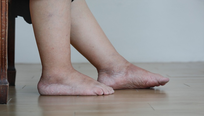 Kaki Sering Bengkak saat Duduk Lama, Waspada Penyakit Jantung