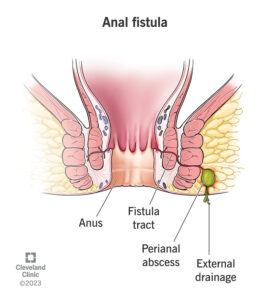 Fistula Ani (Sumber: Cleveland Clinic)