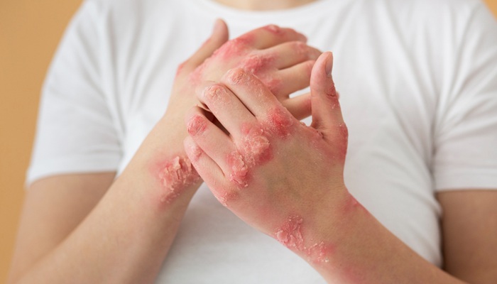 Penderita Lupus Bisa Tenang, Mandaya Puri Miliki Klinik Autoimun & Reumatologi