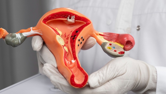 Pengobatan Kanker Ovarium Stadium 4 Metode CRS-HIPEC di Mandaya