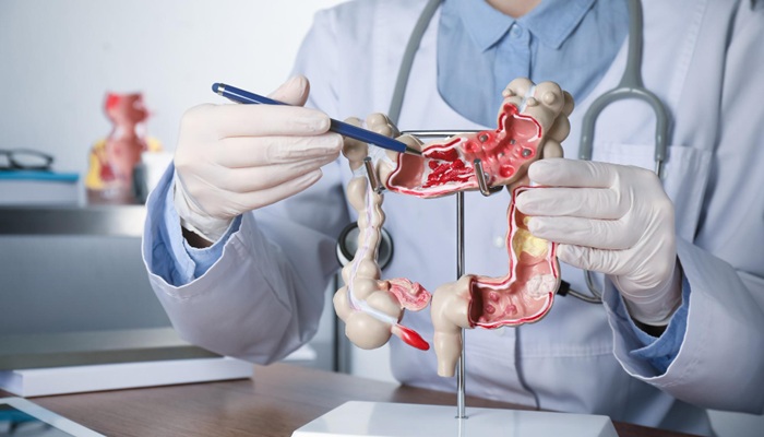 Penanganan Kanker Usus Besar Stadium Akhir Metode CRS-HIPEC di Mandaya