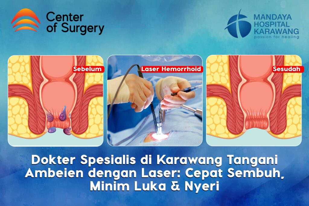 Dokter Spesialis Bedah Karawang Tangani Ambeien (Wasir) dengan Laser: Cepat Sembuh, Minim Luka & Nyeri