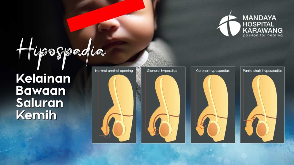 Kelainan Bawaan Saluran Kemih: Hipospadia oleh dr. Muhammad Baihaqy Ibnu Hakim, Sp.U.,FICS RS Mandaya Karawang
