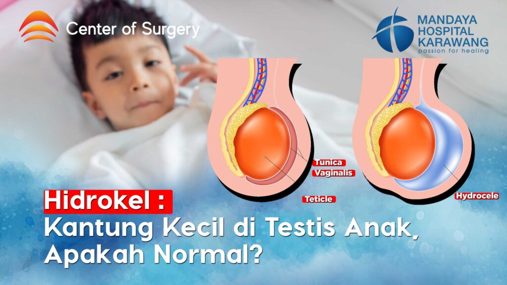 Hidrokel: Kantung Kecil di Testis Anak, Apakah Normal?