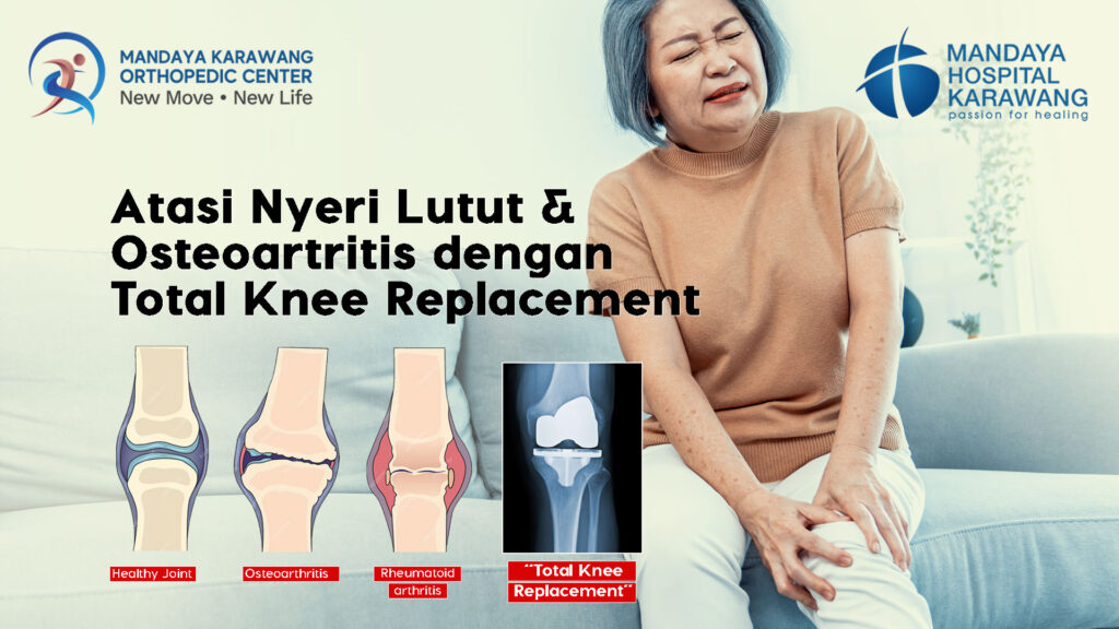 Atasi Nyeri Lutut dan Osteoartritis dengan Total Knee Replacement di RS Mandaya Karawang