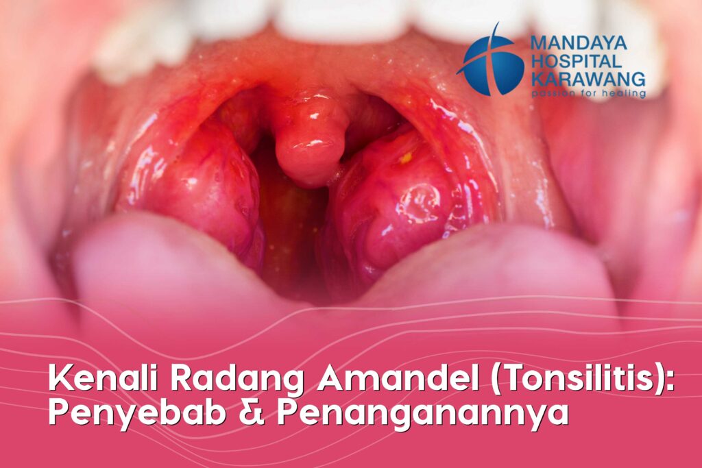 Kenali Radang Amandel (Tonsilitis): Penyebab, Gejala & Penanganannya