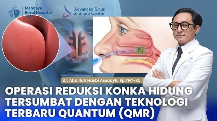 Pengobatan Radang Konka Hidung dan Ngorok Dengan Teknologi QMR di RS Mandaya Royal Puri