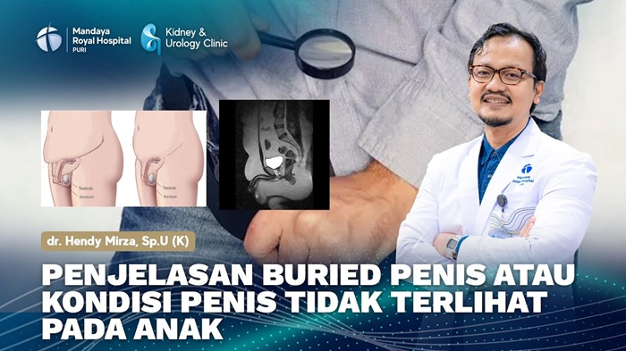 Buried Penis pada Anak: Penjelasan dr. Hendy dari RS Mandaya Royal Puri