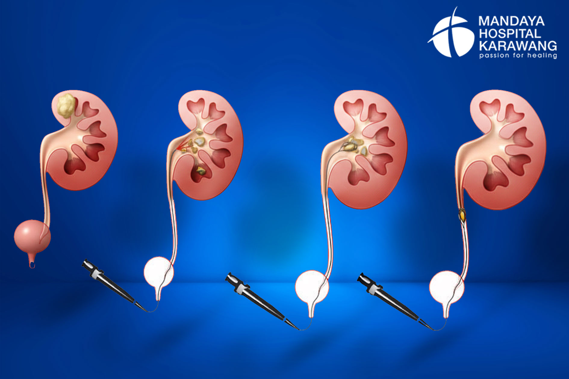 Canggih, Metode RIRS Atasi Batu Ginjal Minim Nyeri & Tanpa Sayatan di ...