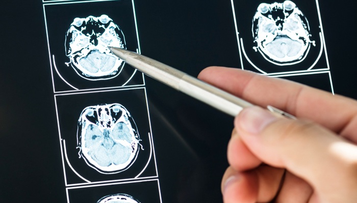 Apakah Tumor Otak Bisa Sembuh? Pahami Penjelasannya Ini