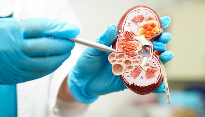 Persiapan Cangkok Ginjal Bagi Pendonor dan Resipien, RS Mandaya Royal Puri