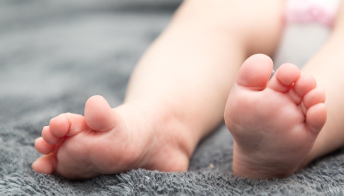 Operasi Jari Kaki Berlebih dan Menyatu pada Anak oleh dr. Jecky di RS Mandaya Puri