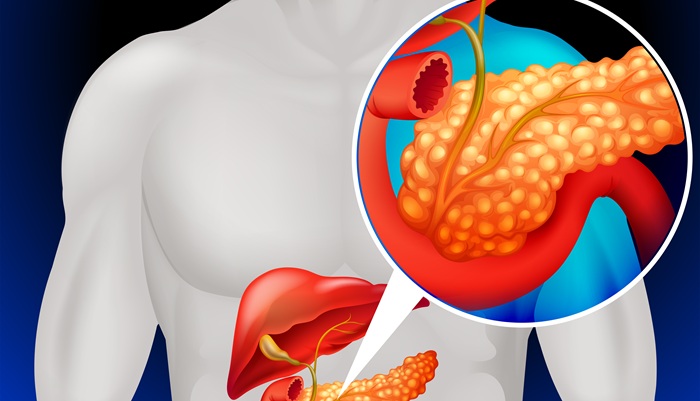 Harapan Baru Kanker Pankreas Stadium Lanjut dengan HIFU Ada di RS Mandaya Royal Puri