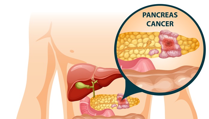 Redakan Nyeri Akibat Kanker Pankreas dengan HIFU, RS Mandaya Royal Puri