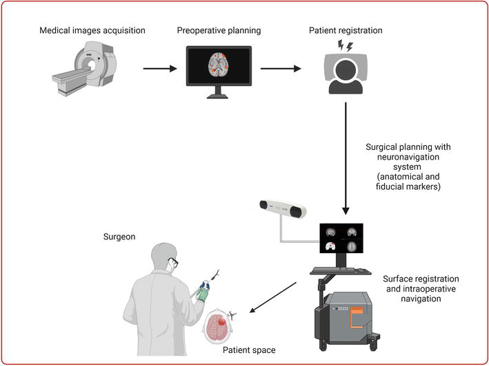 Ilustrasi cara kerja Brainlab Neuronavigation 3D System (Sumber: intechopen)