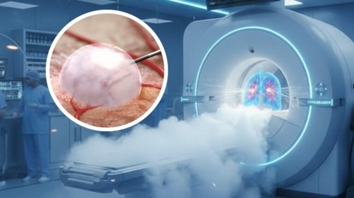 Mengenal Krioterapi, Metode Pengobatan Kanker dengan Teknologi Pembekuan