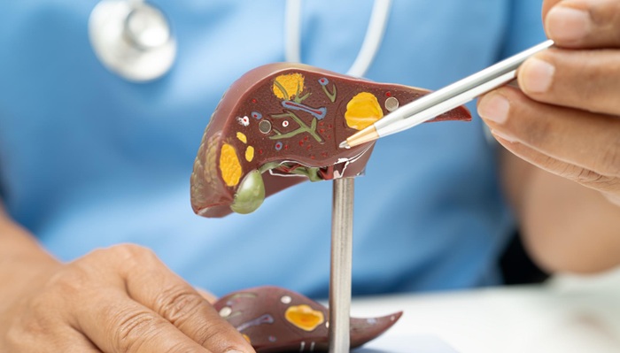 Efektivitas TARE Y-90 untuk Kanker Hati: Hasil, Manfaat, dan Prosedurnya