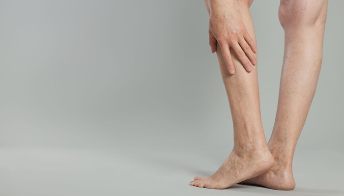 Atasi Varises Tanpa Operasi di RS Mandaya Karawang