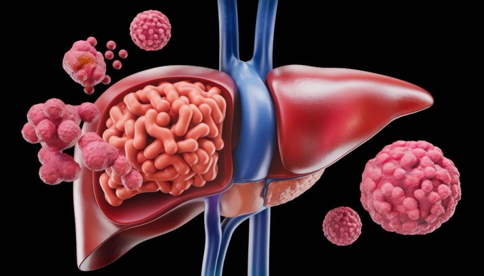 Keunggulan TARE Y-90 dari TACE untuk Kanker Hati: Penjelasan oleh dr. Sugianto Santoso, Sp.Rad (K)RI dari RS Mandaya