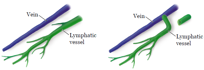 Lymphaticovenular Anastomosis (LVA) (Sumber: Memorial Sloan Kettering Cancer Center)