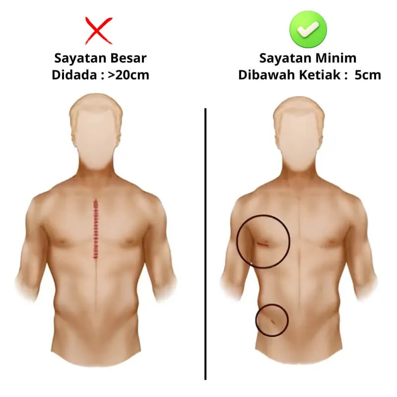 Operasi bypass jantung metode MICS. (Sumber: dokterwirya.id)