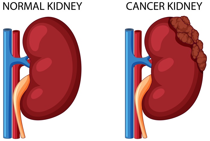 Ilustrasi ginjal sehat dan ginjal dengan kanker.