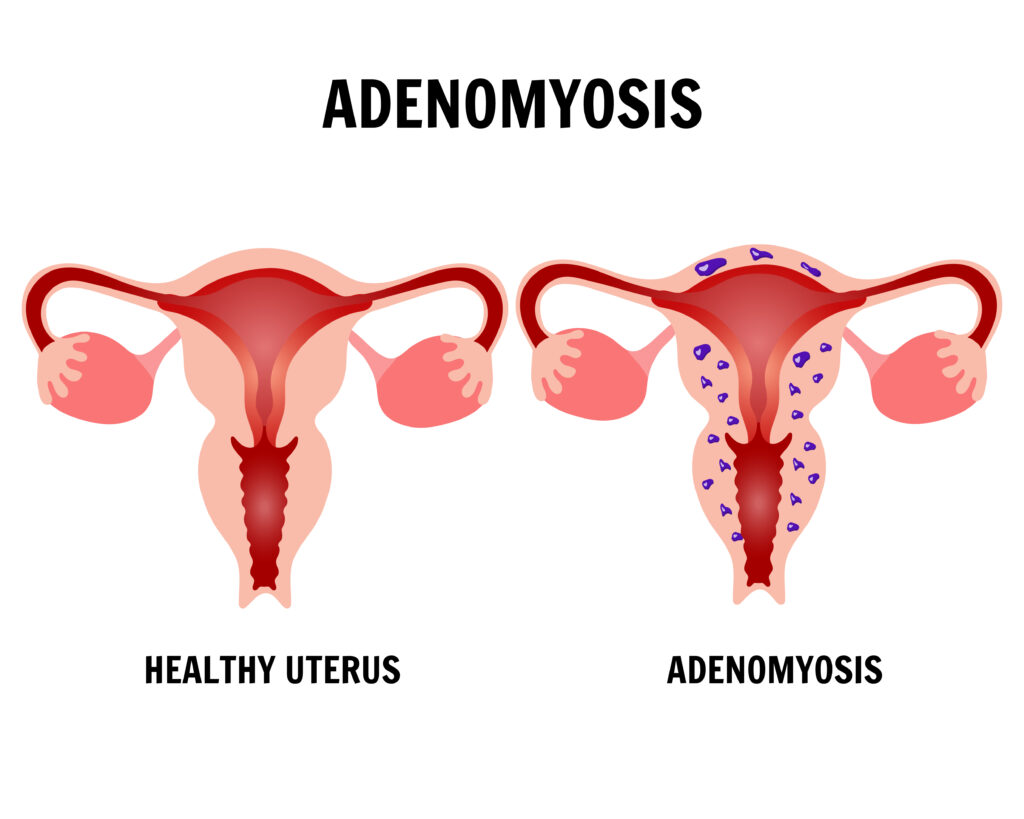 Adenomiosis