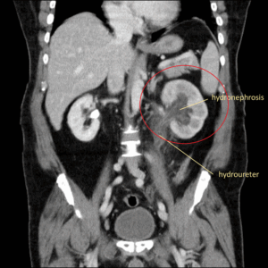 Hidronefrosis (Sumber: Radiology Cafe)