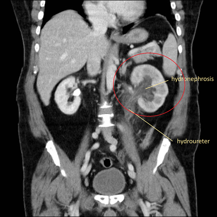 Ilustrasi hidronefrosis (Sumber: Radiology Cafe)