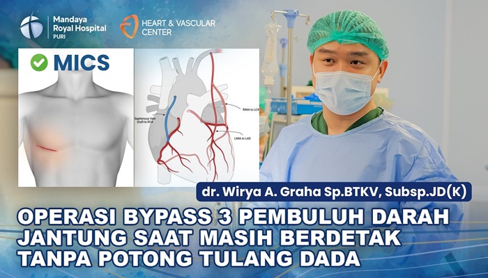 Pasien 65 Tahun Lakukan Operasi Bypass Jantung Minimal Invasif dengan dr. Wirya di RS Mandaya Puri