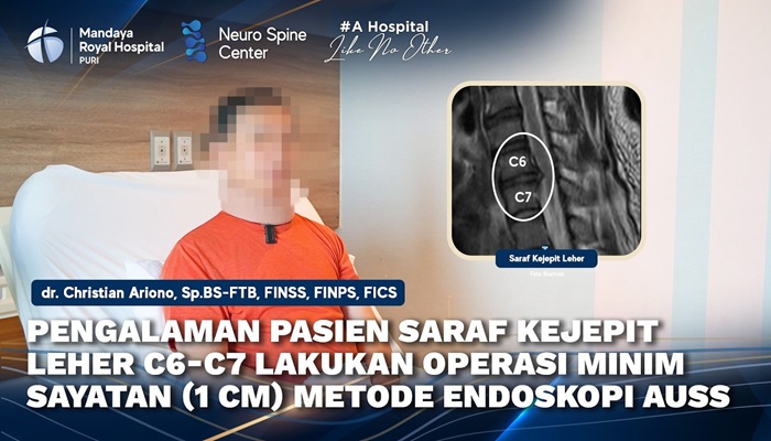 Pengalaman Pasien Saraf Kejepit Leher C6-C7 Jalani Tindakan AUSS dengan dr. Christian Ariono di RS Mandaya Puri