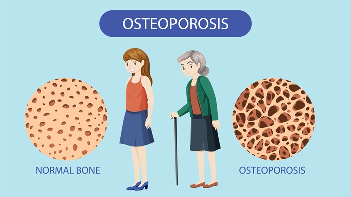 Perbedaan tulang sehat dan osteoporosis