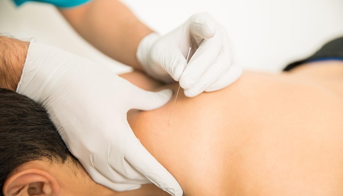 Getting to Know Dry Needling Therapy for Muscle Pain and Tension Relief