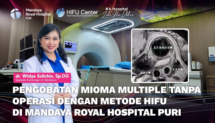 Pengobatan Miom Rahim Ukuran 3,7 x 4,3 Cm dengan HIFU Tanpa Operasi oleh dr. Widya Sp.OG di RS Mandaya Puri